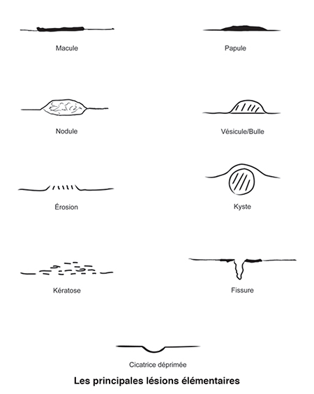 Une dermatose peut être considérée, dans tous les sens du terme, comme un véritable « tableau cutané » en 3d, qui raconte l’histoire de la maladie ; une étude analytique de cette représentation permet de reconnaître un certain nombre de lésions de base, dites « élémentaires », perçues à la vue et/ou au toucher et se référant à la couleur, à la texture, au relief de la peau.