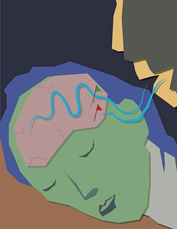 Des scientifiques du CNRS et de l’ENS-PSL1 viennent de montrer que le cerveau supprime des informations du monde extérieur, comme les bruits d’une conversation, pendant la phase de sommeil paradoxal liée aux rêves. Cette aptitude pourrait être l’un des mécanismes protecteurs des rêves. Cette étude, réalisée en collaboration avec le Centre du sommeil et de la vigilance de l’AP-HP, est publiée dans Current Biology le 14 mai 2020.